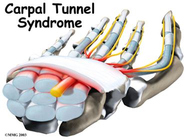 Carpal tunnel syndrome