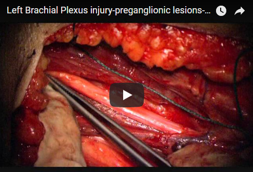 Video: Left Brachial Plexus injury-preganglionic lesions-neurotization