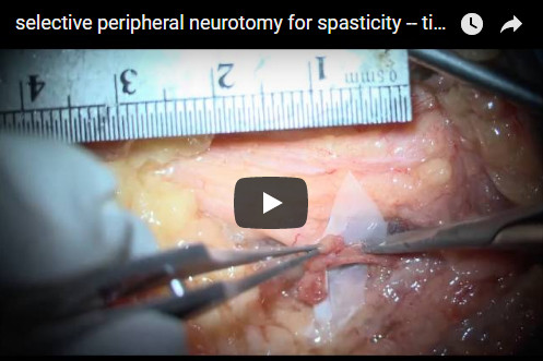 Video: Elective Peripheral Neurotomy For Spasticity — Tibial Nerve